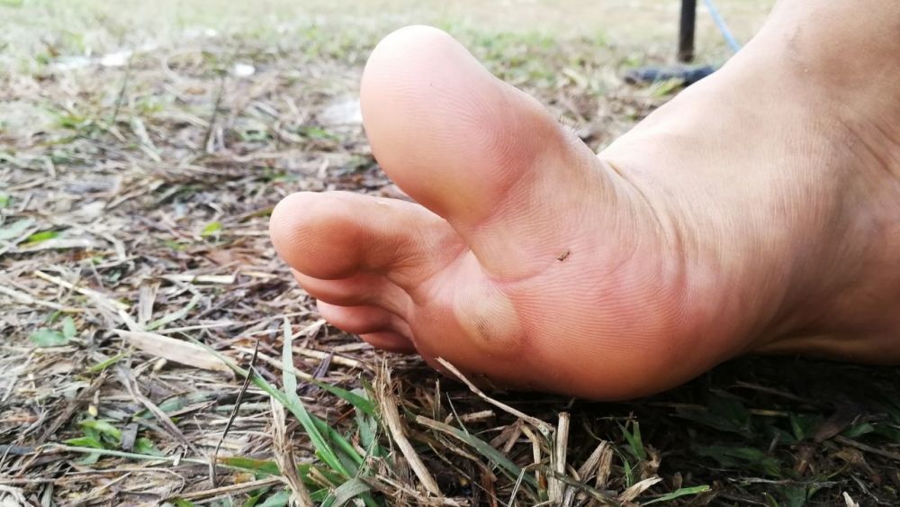 You should treat blisters as soon as possible