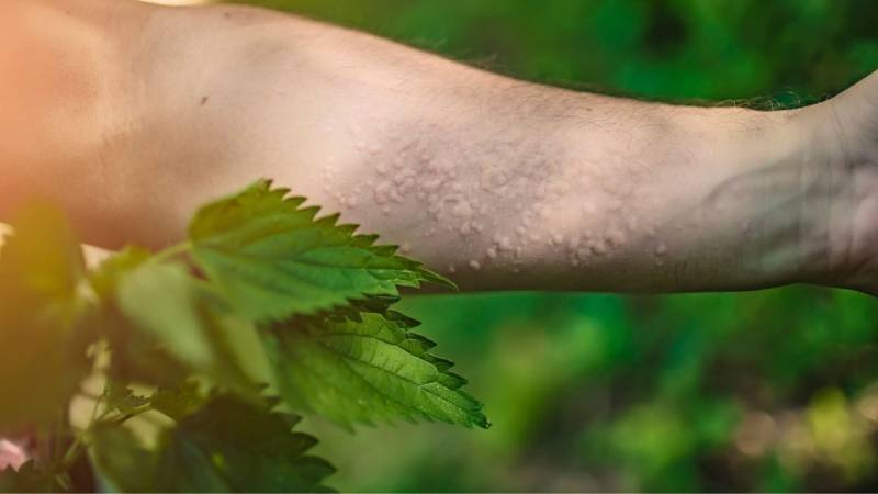 A stinging nettle can trigger a severe reaction (welts)