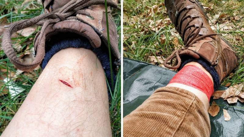 Carelessness and recklessness are not good companions in the wilderness – here I hacked into my own leg with my axe