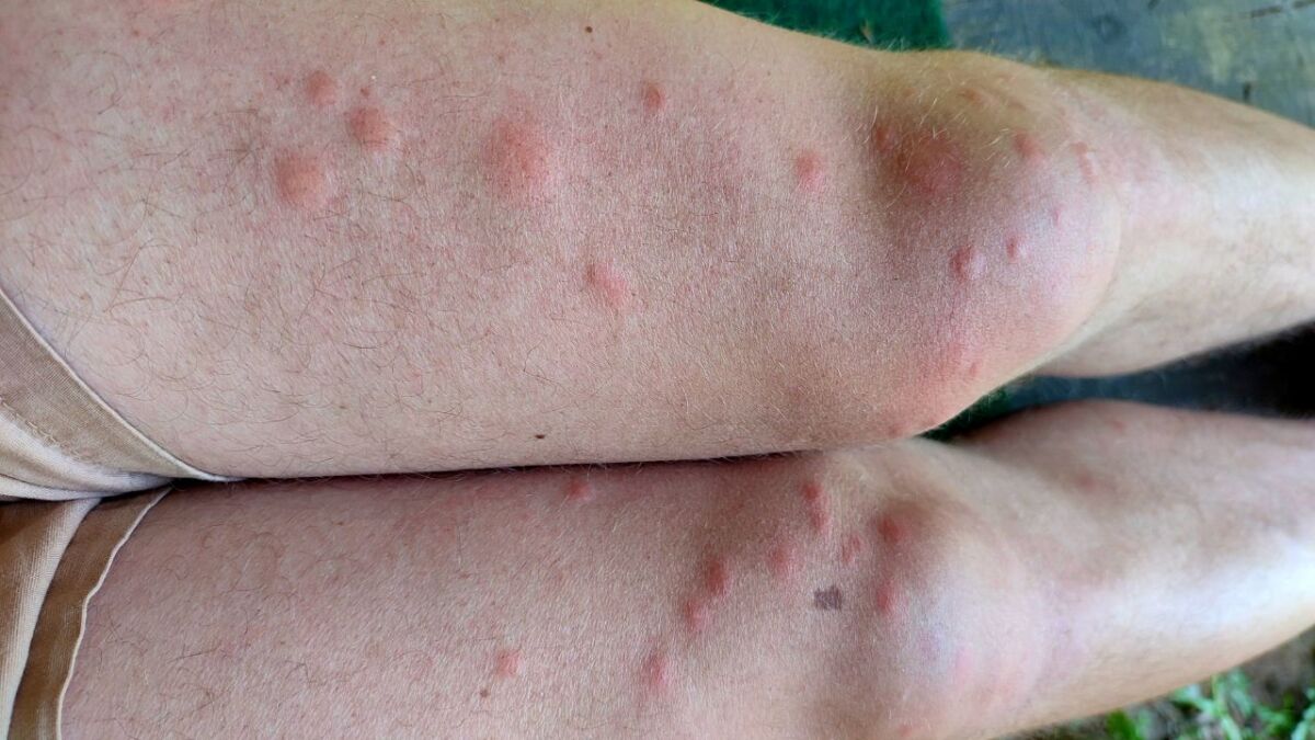 This is what my legs looked like after a day in the forest - I learned from this and now I protect myself