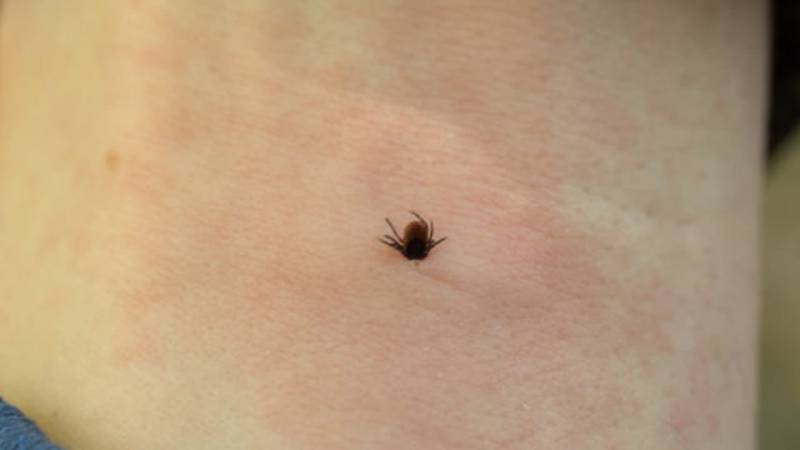 Tick bite